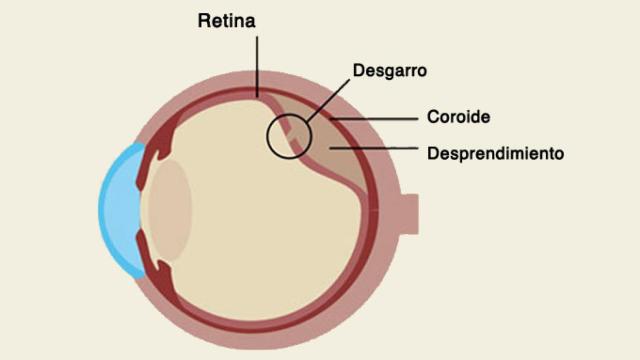 desprendimiento_ojo