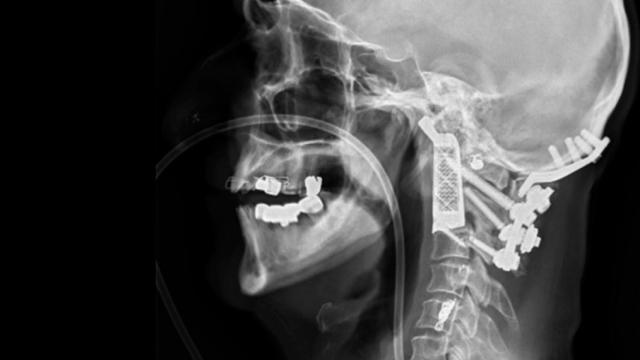 impresion-3d-vertebra