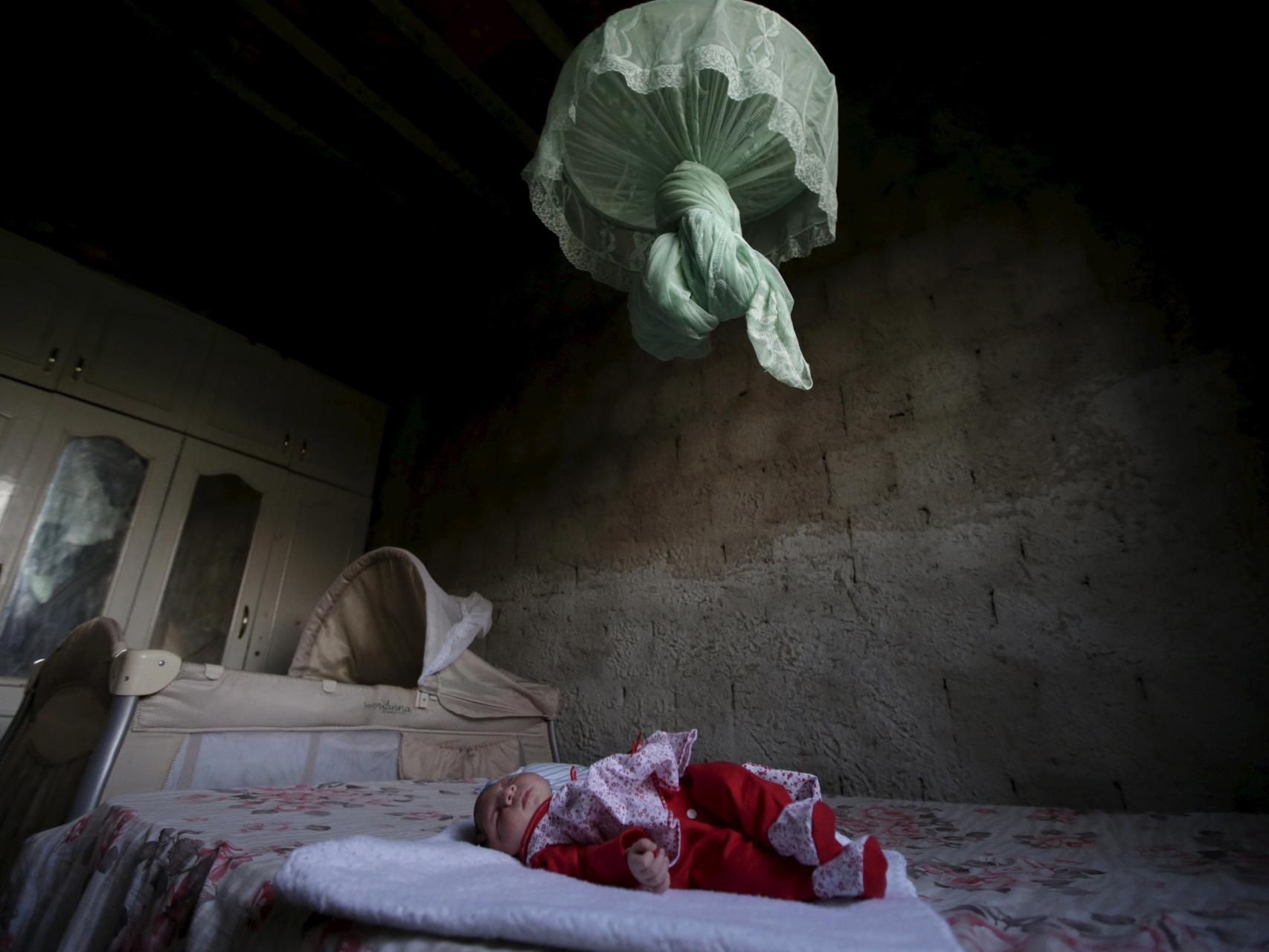 Un bebé con microcefalia.