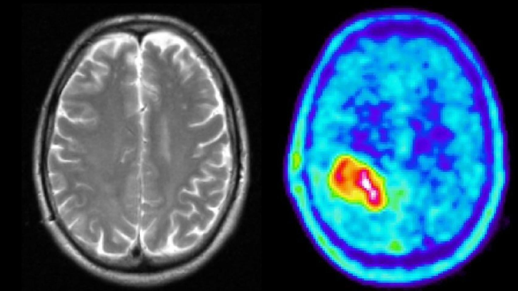 Tumores cerebrales.