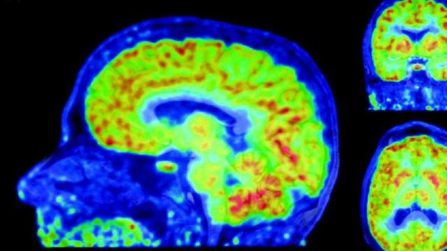 cerebro