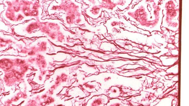 Tejido hepático de un enfermo de esta fiebre.