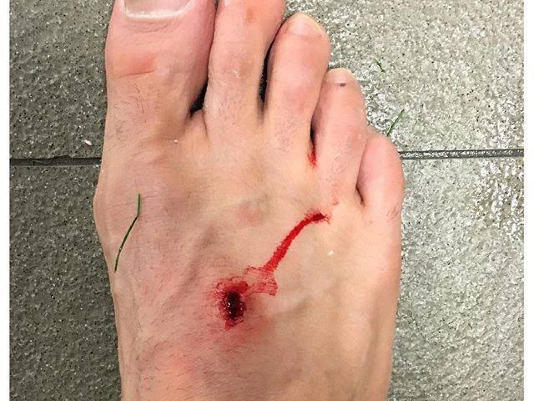 El pie de Filipe Luis tras la entrada de Luis Suárez.