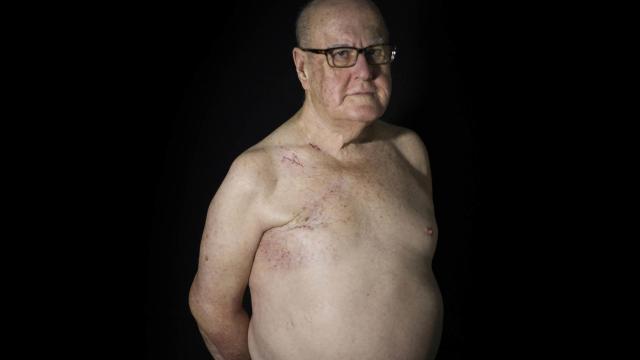 Un 1% de los casos de cáncer de mama se dan en varones.