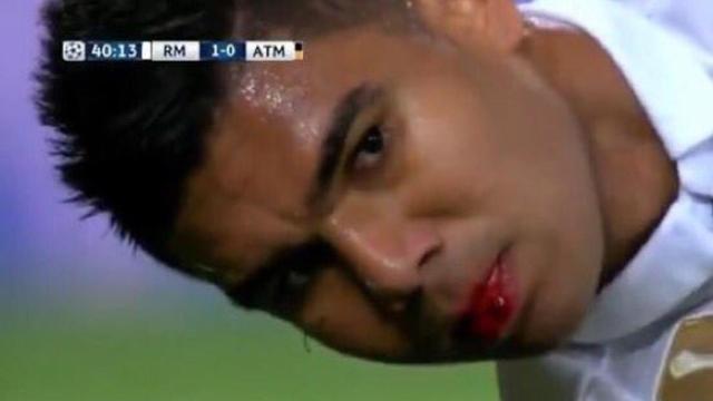 Así sangró Casemiro tras el codazo de Godín.