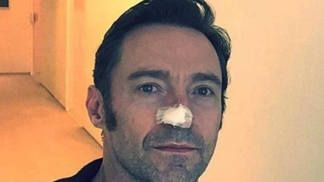 El actor Hugh Jackman tiene cáncer de piel