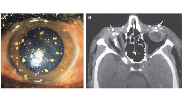 El caso del hombre cuyo ojo reventó cuando explotó el petardo que encendía