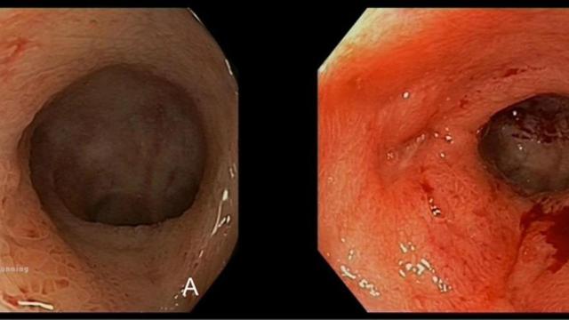 Imágenes del ileón, la parte final del intestino delgado, del paciente.