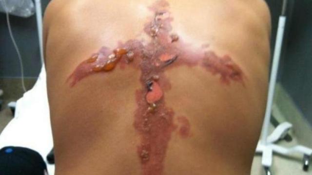 Las quemaduras, como las de este adolescente estadounidense, pueden tener consecuencias irreversibles.