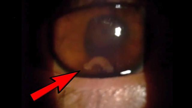 El parásito observado durante la exploración.