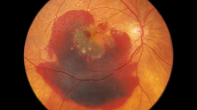 Un globo ocular con degeneración macular.