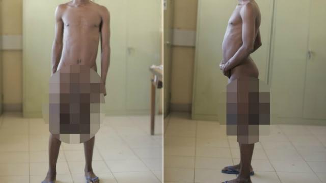 Forence sufría elefantiasis escrotal, una enfermedad que le provocaba tremendos dolores.