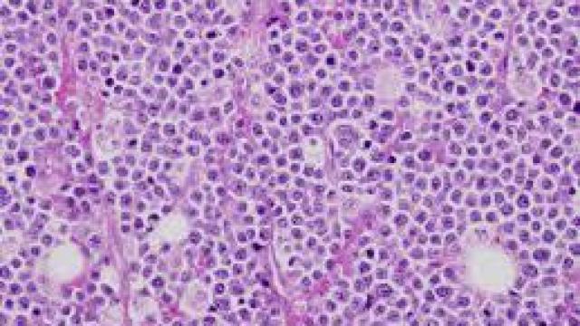 Un mieloma al microscopio.