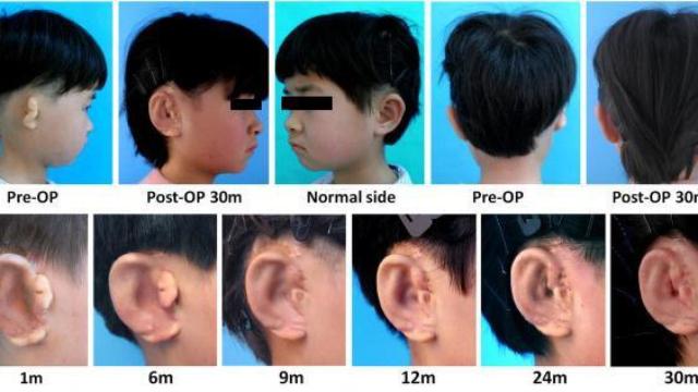Imágenes de los niños con orejas 'impresas'.