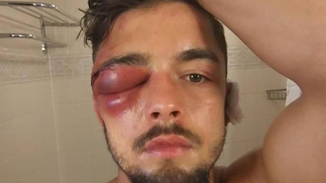 Anthony Yigit con el ojo morado