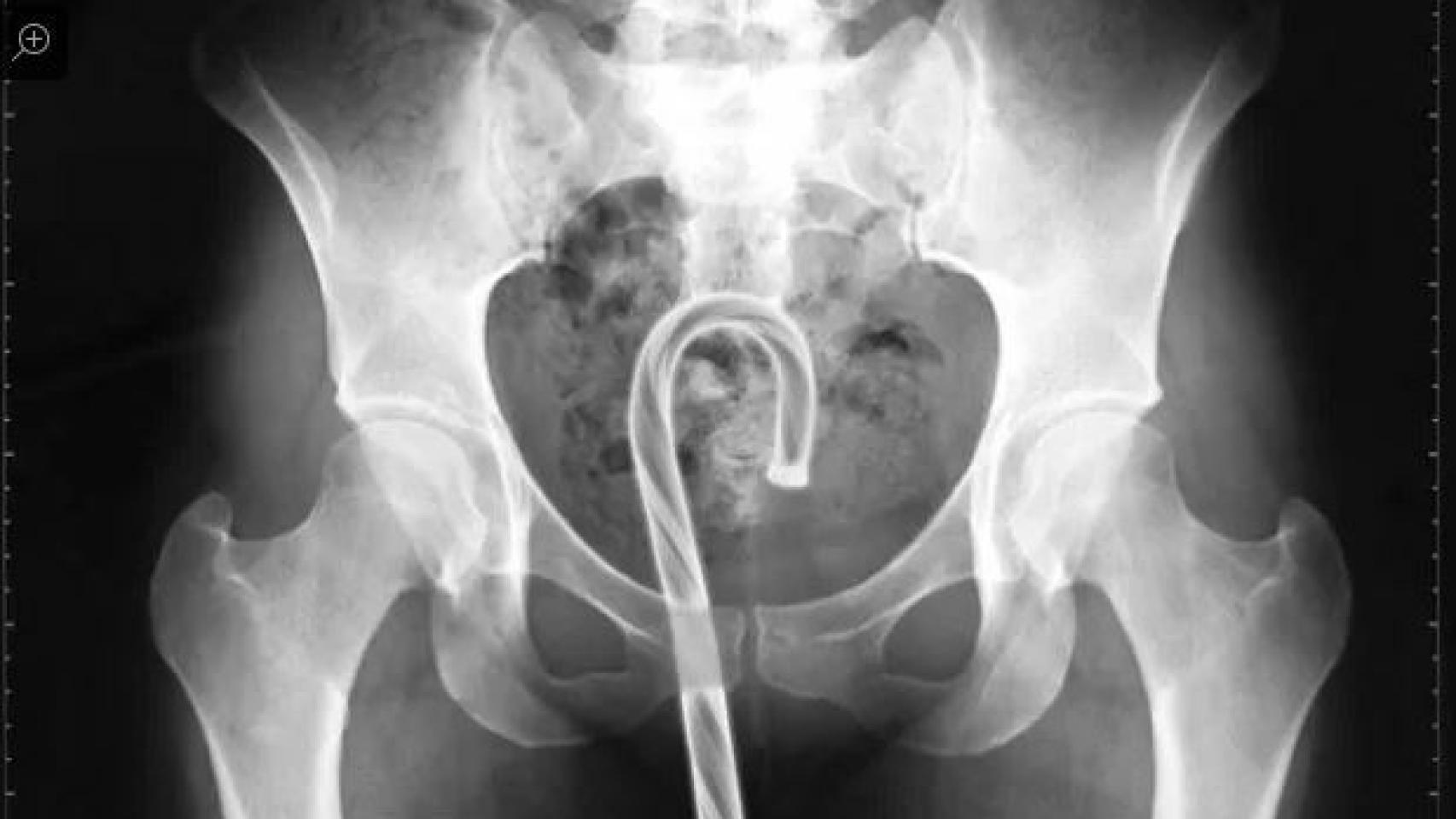 Estos son los objetos más extraños que se han encontrado en Urgencias.