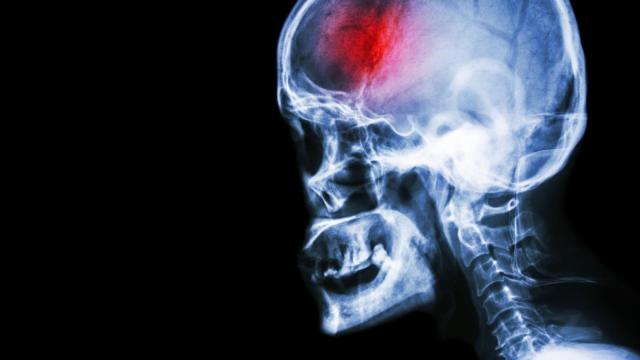 El ictus o infarto cerebral se produce por la obstrucción de una arteria.