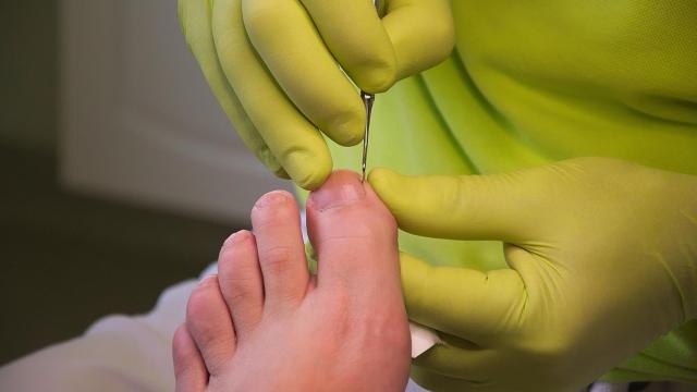 Los antimicóticos naturales son productos muy efectivos