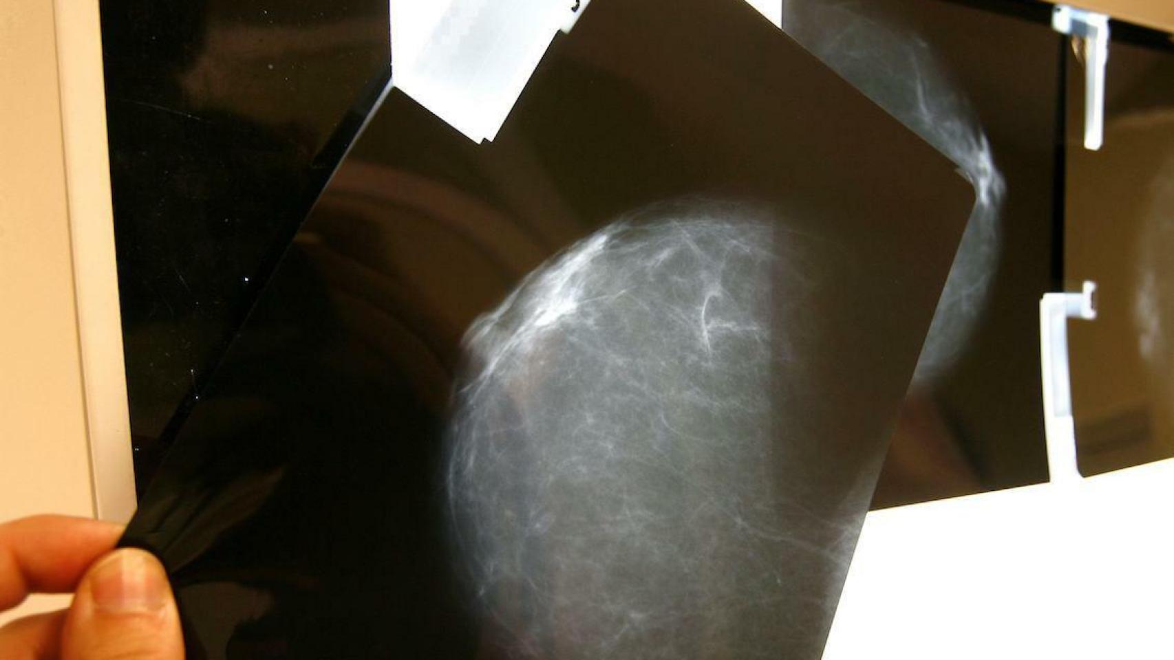 Radiografía para detectar cáncer de mama. Foto: EFE