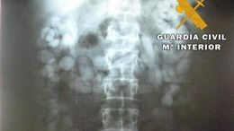 Radiografía del torso del hombre detenido