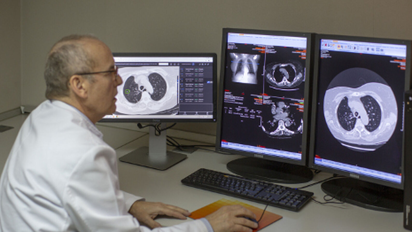Un médico revisa pruebas de diagnóstico por imagen en cáncer de pulmón.
