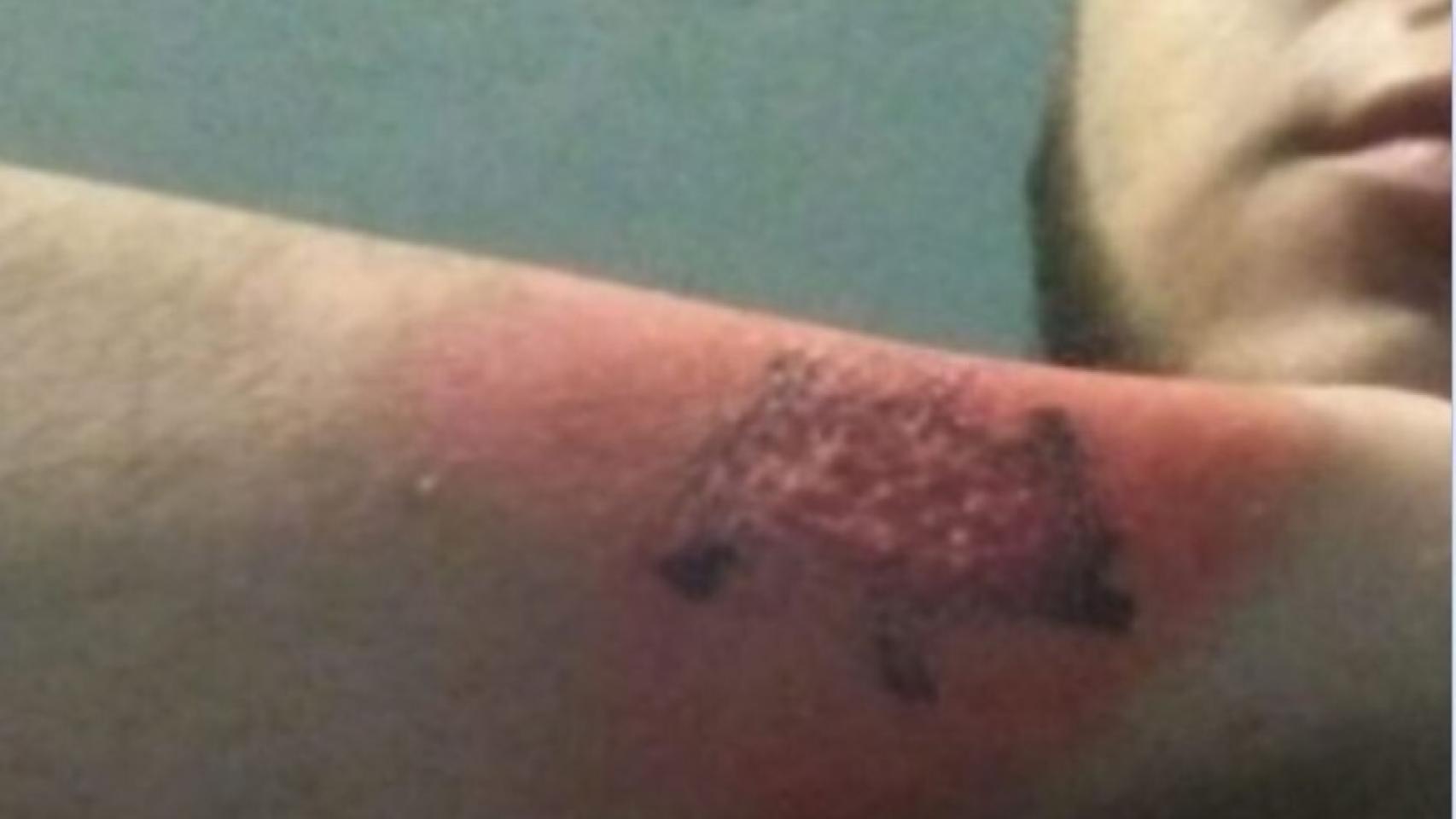 Así tenía el brazo en plena 'operación' para quitarse el tatuaje