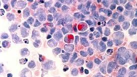 Células tumorales de leucemia.