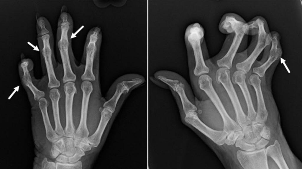 Radiografía de las manos de una enferma de artritis reumatoide. Learningradiology.com