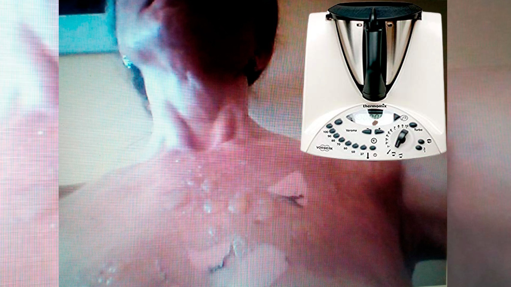 Marcelina sufrió quemaduras en el pecho, en el brazo y en el cuello.