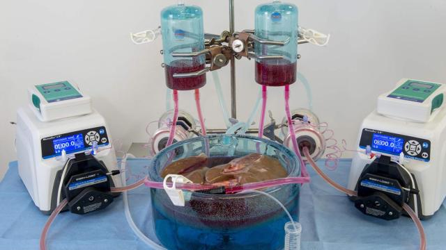 Una nueva técnica amplía el tiempo de vida útil de un hígado de 12 a 27 horas.