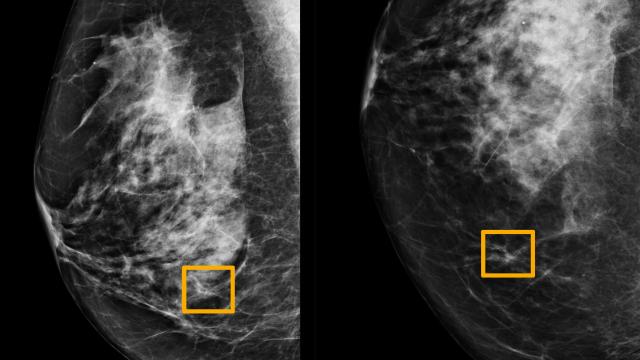 A yellow box indicates where an artificial intelligence (AI) system found cancer hiding inside breast tissue