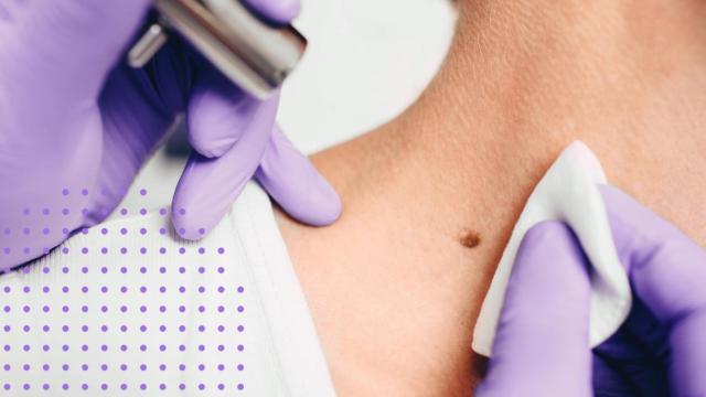 Un dermatólogo estudiando un lunar.
