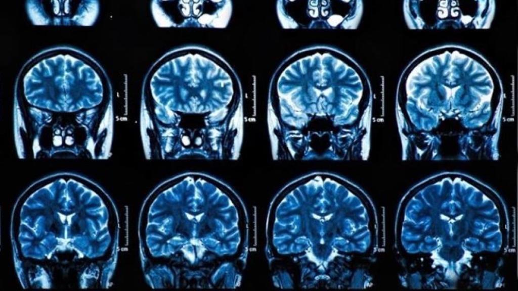 Un escáner cerebral.