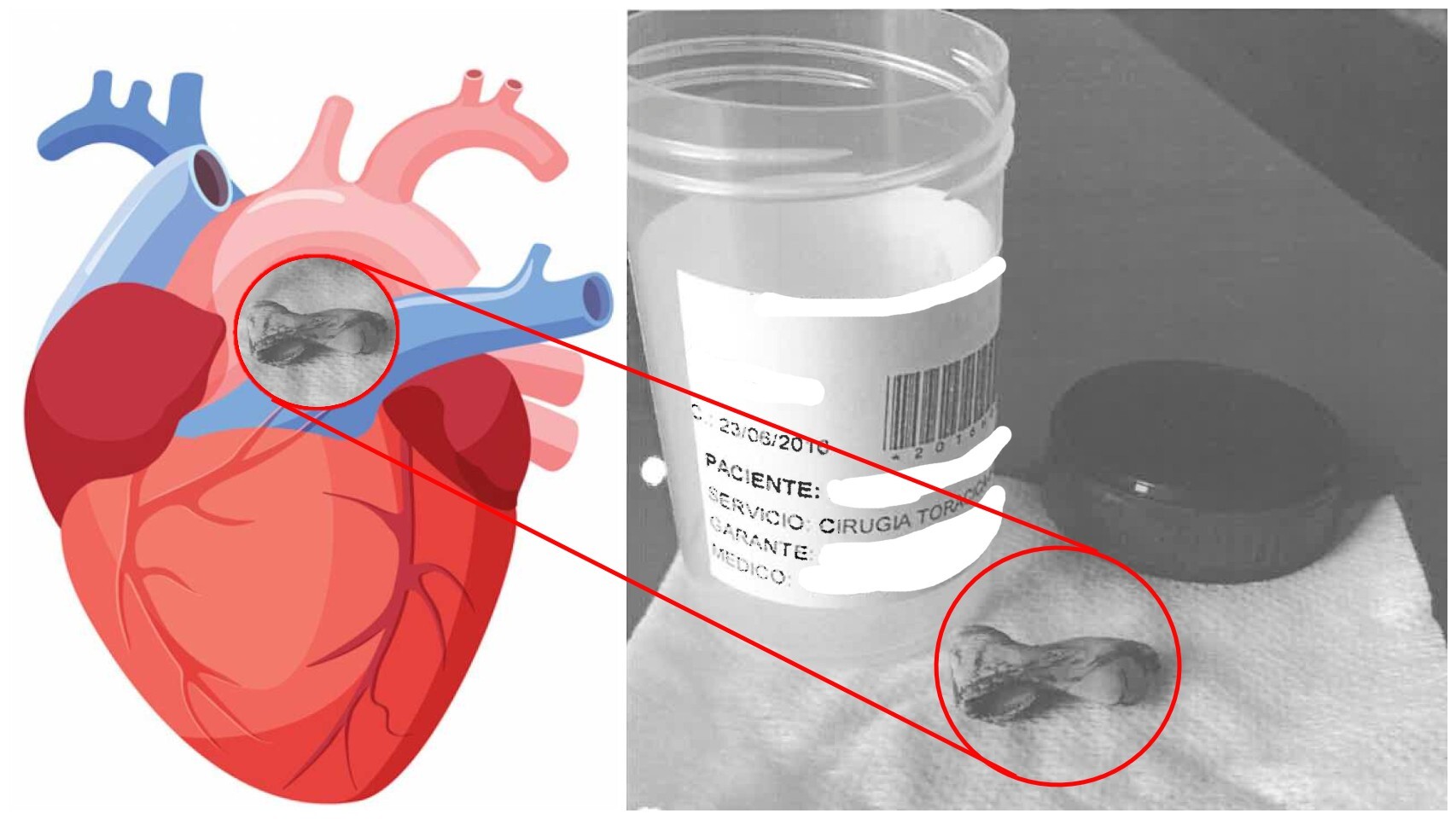 El trozo de cemento de tres centímetros de largo por uno de ancho extraído de la arteria pulmonar derecha, junto al corazón.