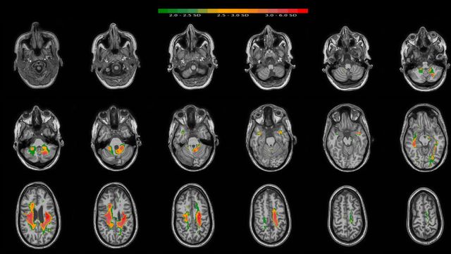 Uno de los ejemplos de detección de anomalías en el cerebro de esta startup coruñesa