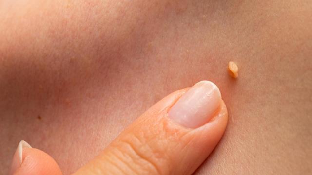 ¡Elimina las verrugas rápido! con vinagre de manzana