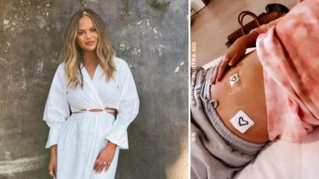 La modelo, Chrissy Teigen, y una imagen de su tripa que subió a las redes sociales tras la operación.