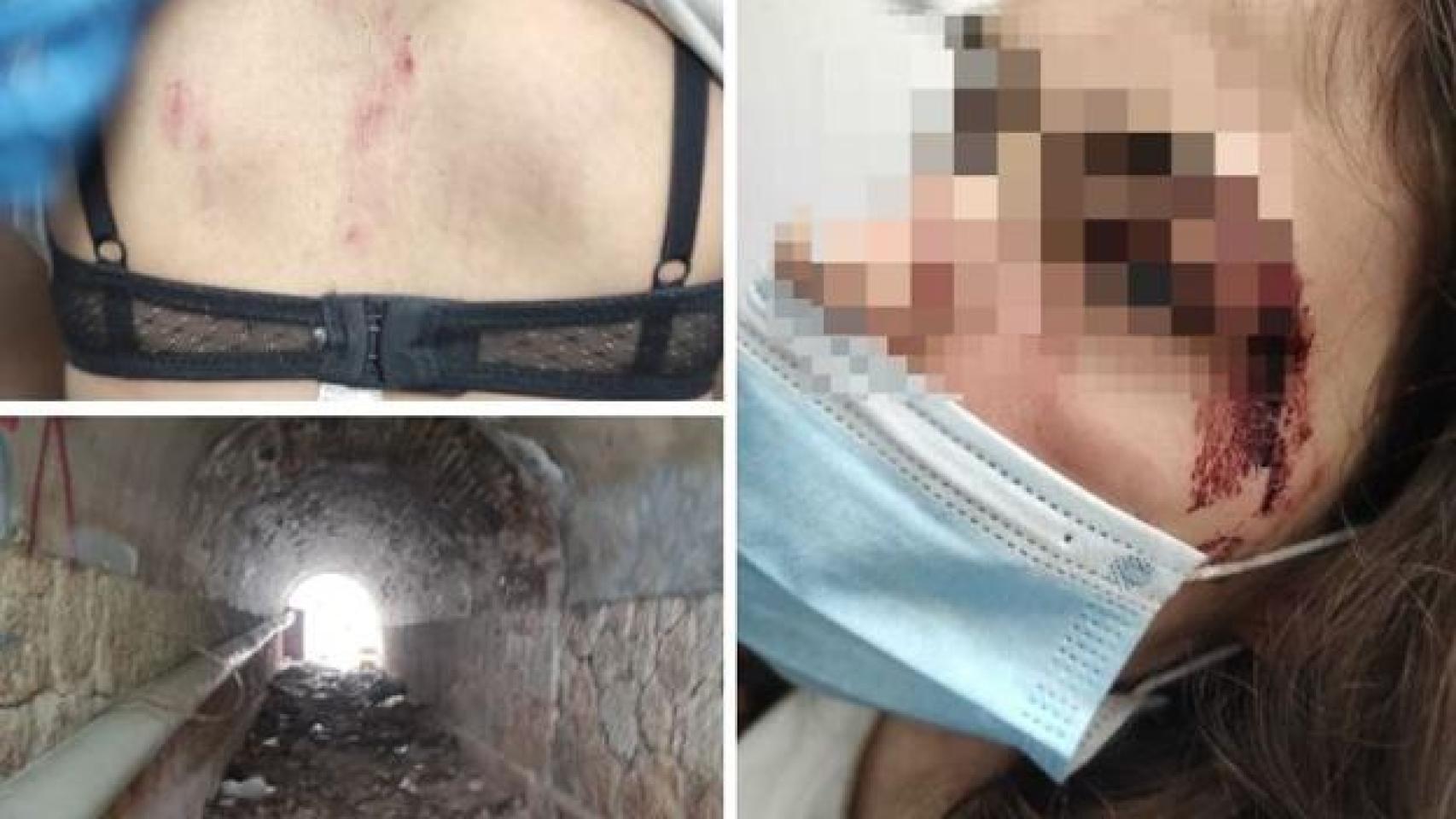 Heridas de la joven agredida