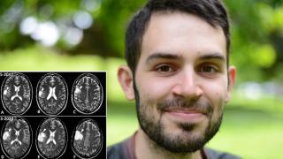 Pablo, superviviente de glioblastoma, y la progresión de su tumor de 2017 a 2021.