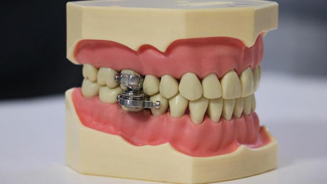 El dispositivo para adelgazar: imanes en la boca para perder 6 kilos en 14 días