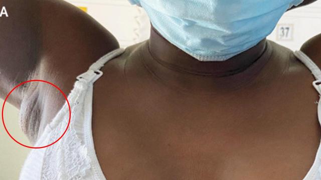 La masa de tejido mamario detectada en la axila de la paciente I N Engl J Med