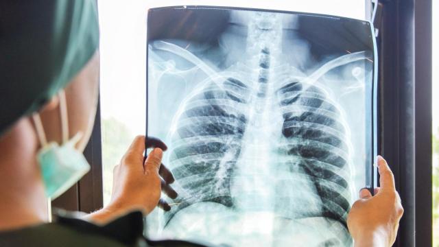 La Unidad de Pleura del Servicio de Neumología de Santiago, entre las mejores del mundo