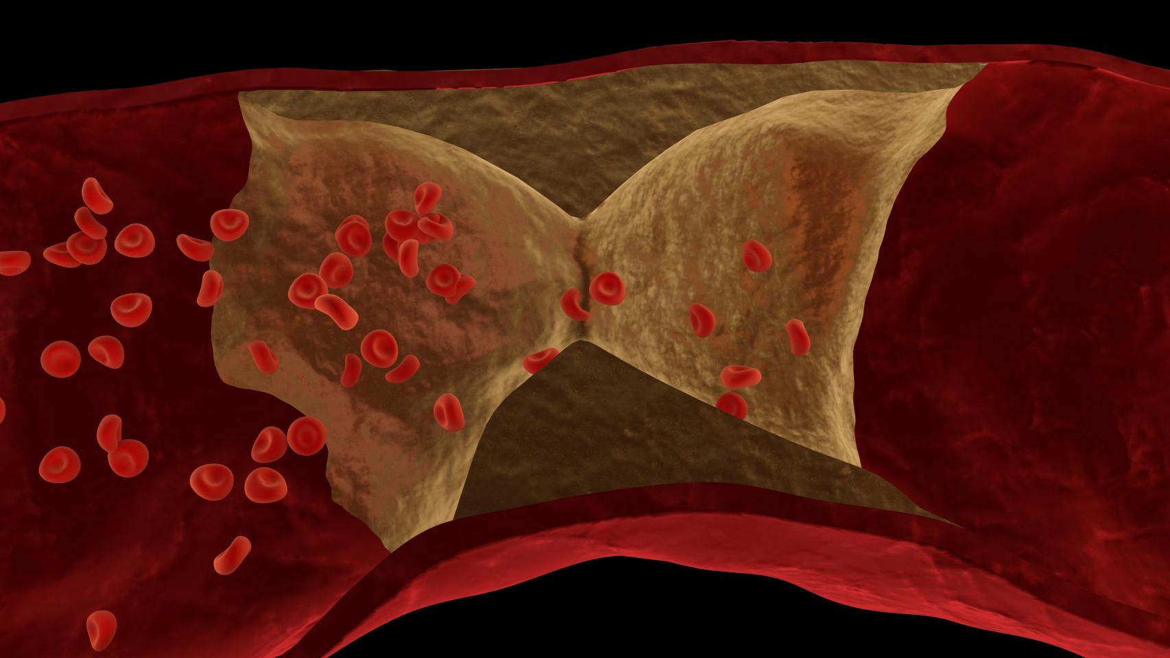 Aterosclerosis: depósitos de colesterol y grasas que taponan las arterias.