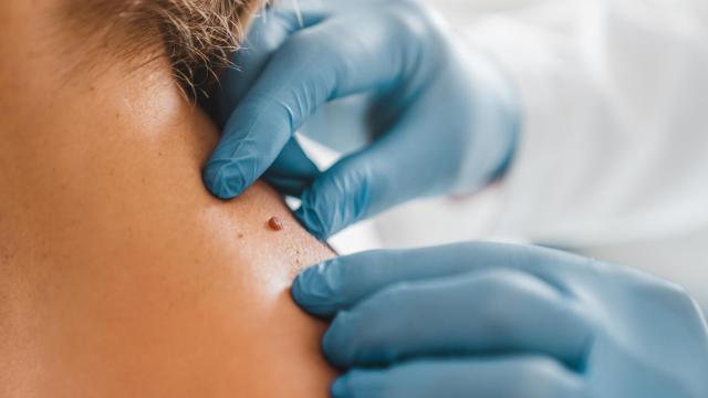 Una mujer con melanoma. Imagen de archivo.