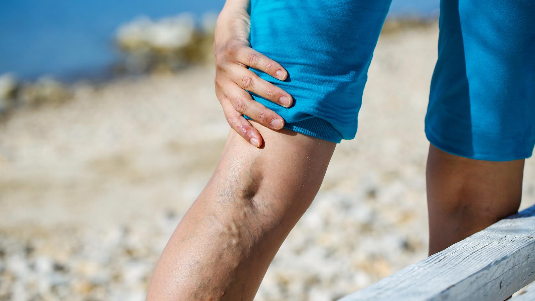 Las varices se han convertido en un problema de salud muy habitual a ciertas edades.