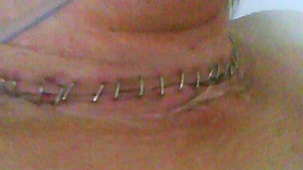 Una de las secuelas de la hemorragia de 2019 fue una operación para acortar la tráquea.