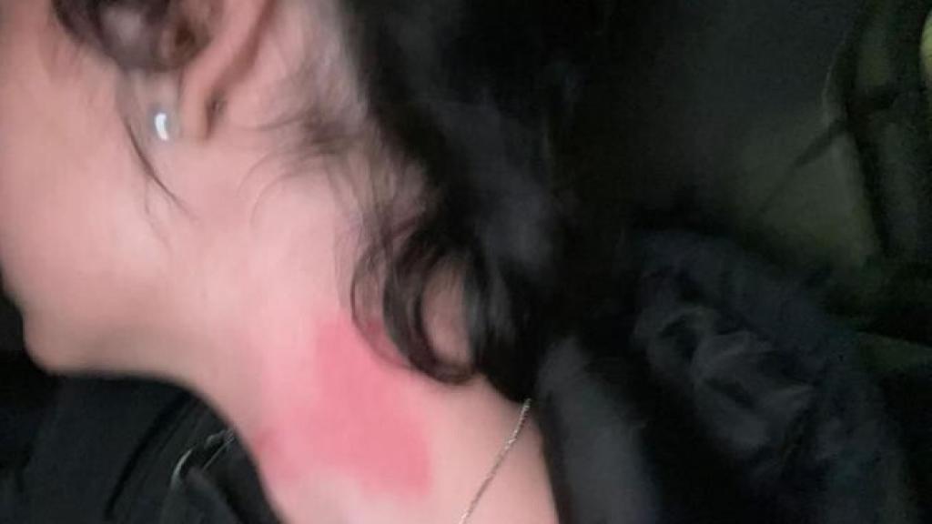 Una de las imágenes de su lesión publicada por Paula en redes sociales.