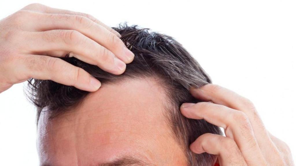 La falta de vitaminas es una causa de la caída del pelo.