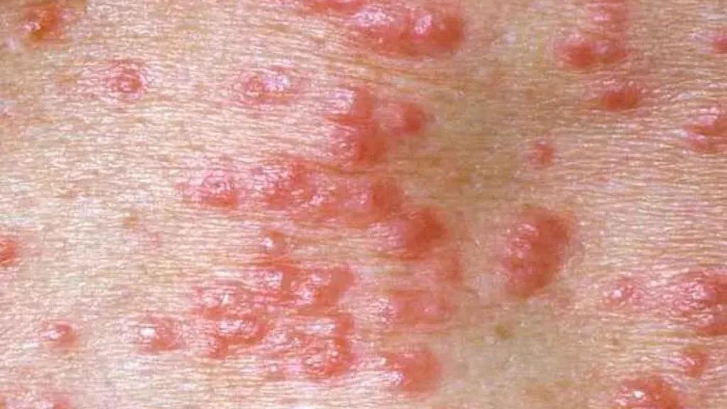 Lesiones cutáneas producidas por sarna