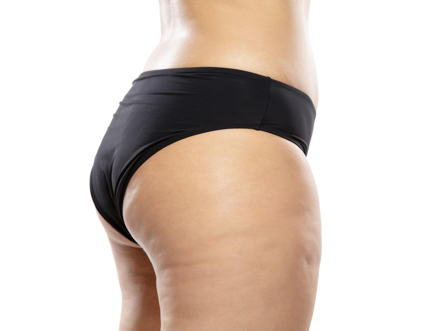 ¿Cómo atacamos la celulitis para conseguir resultados óptimos?